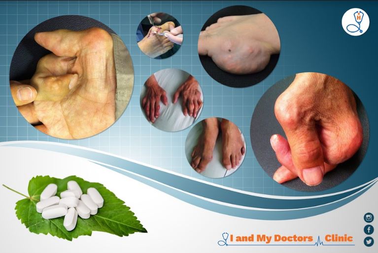 Gout | Symptoms | I and My Doctors Clinic | Call 2813035678 NOW
